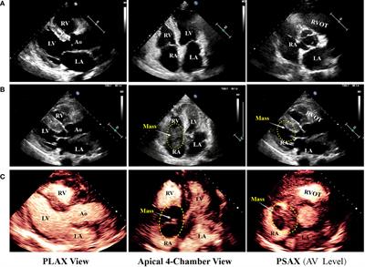 Diagnosis of rapidly progressed primary cardiac lymphoma in liver transplant recipient: A case report